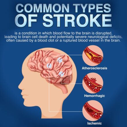 types of stroke 1024x1024 1