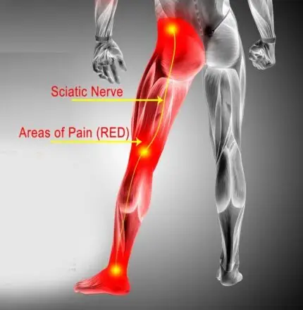 Sciatica Hip Pain Causes Treatment