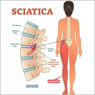 "Diagram illustrating sciatica caused by a herniated disk compressing the sciatic nerve. The image shows the spine with vertebrae, normal disks, and a herniated disk highlighted in red. The herniated disk compresses the sciatic nerve, leading to areas of pain marked in red on the lower back, buttocks, and down the leg. The areas of pain are highlighted on the right side of the image on a diagram of a person's back and leg."