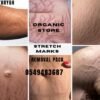 stretch marks removal