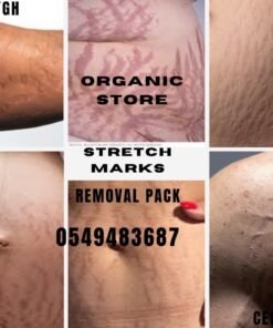 stretch marks removal