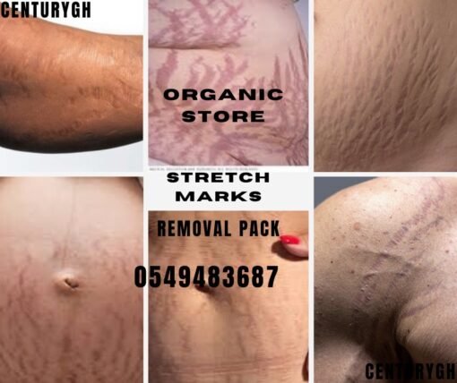 stretch marks removal